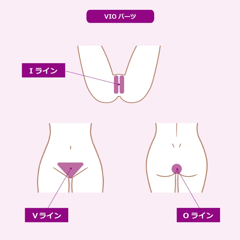 レディース脱毛VIOパーツ表