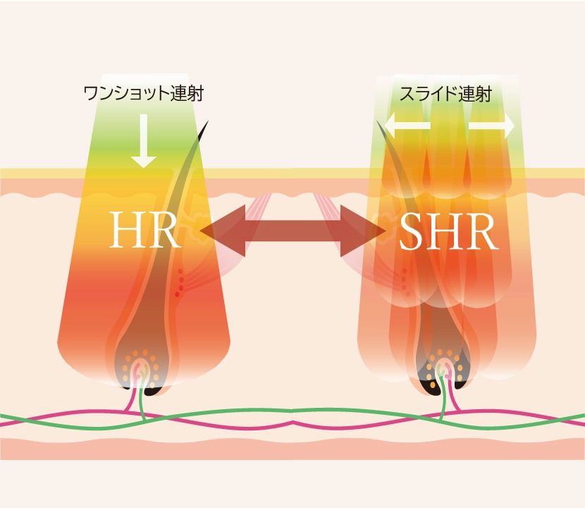 IPLハイブリット脱毛のメカニズム／ステップ①