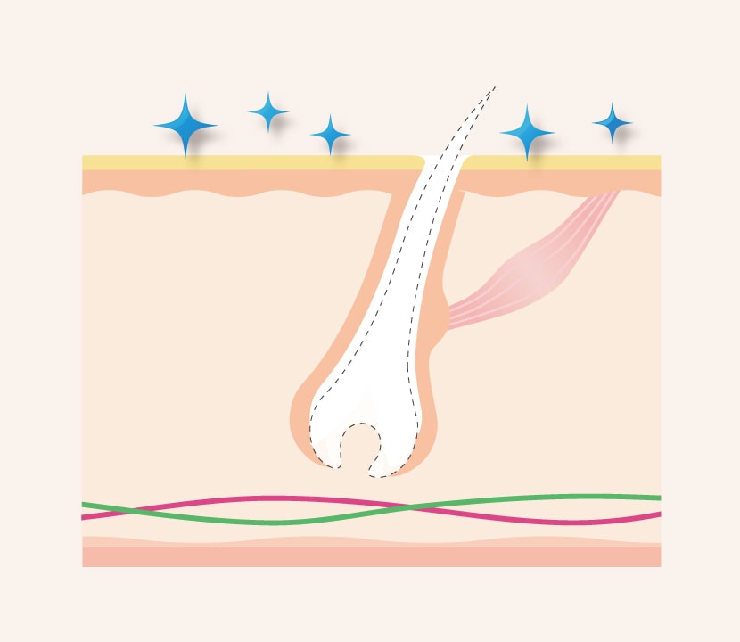 IPLハイブリット脱毛のメカニズム／ステップ④