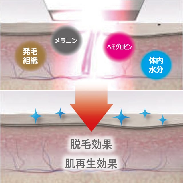 IPL光線美容のメカニズム