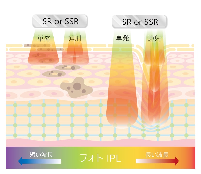 フォトIPLのメカニズム／ステップ①