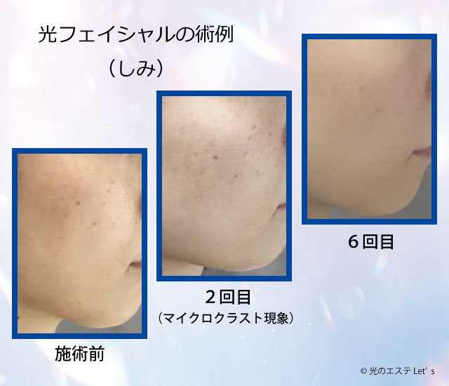 光フェイシャル施術例、しみ、そばかす、くすみ、ビフォーアフター