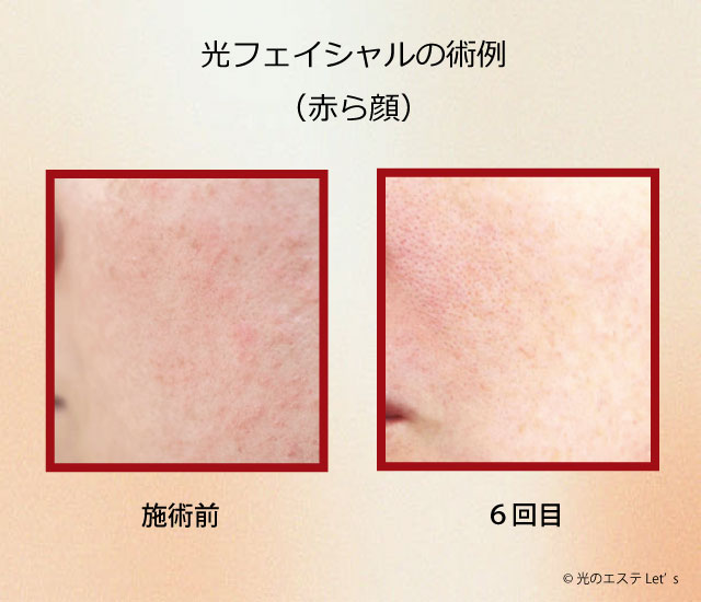 光フェイシャル施術例、赤ら顔、ビフォーアフター