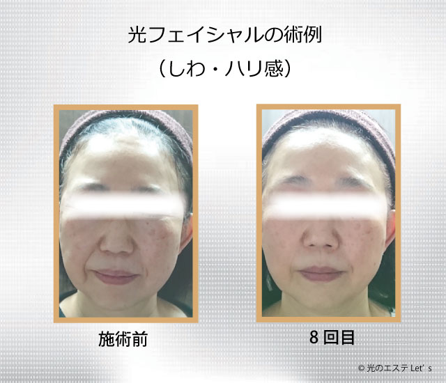 光フェイシャル施術例、しわ、ハリ感、安易エイジング、ビフォーアフター
