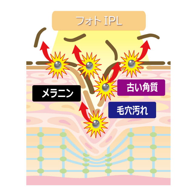 カーボンフェイシャルの手順